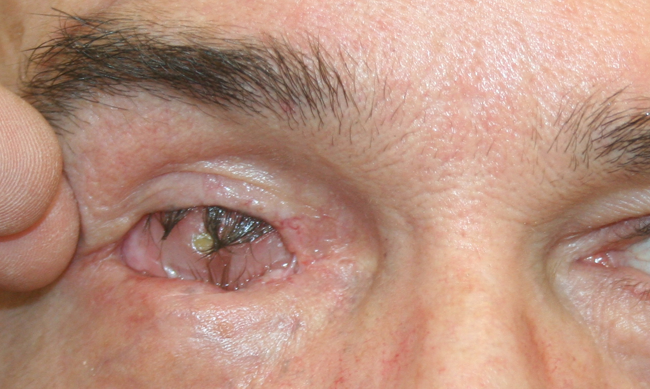 Contracted socket with conformer, following oculoplastic surgery