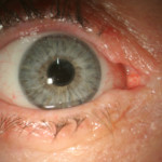 BioEye τεχνητός οφθαλμός - BioEye artificial eye
