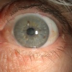 Φυσιολογικός οφθαλμός - Normal eye