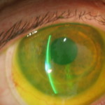 scleral-lens-fitted